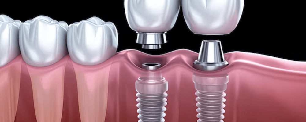 How Implant Dentistry Can Restore Confidence Along With Teeth