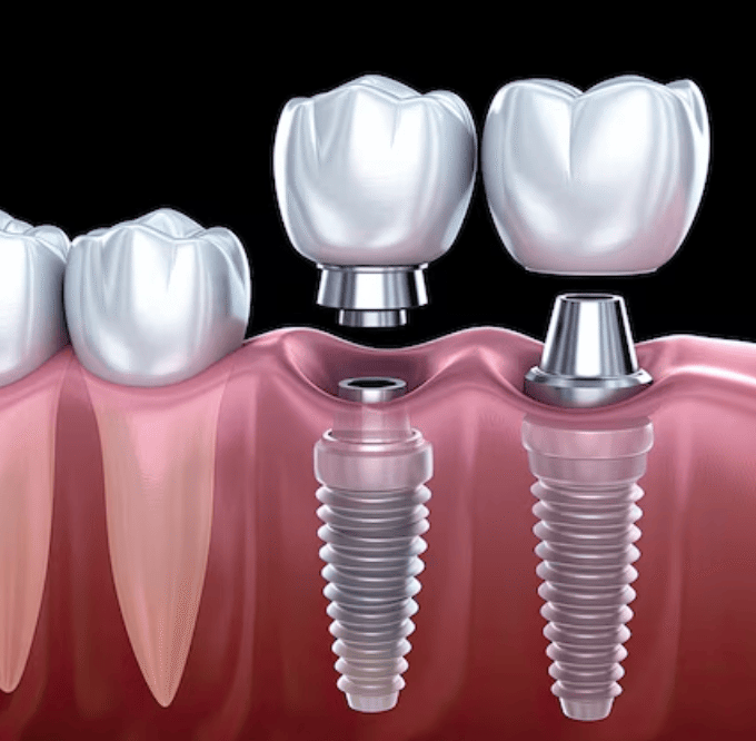 how implant dentistry can restore confidence along with teeth