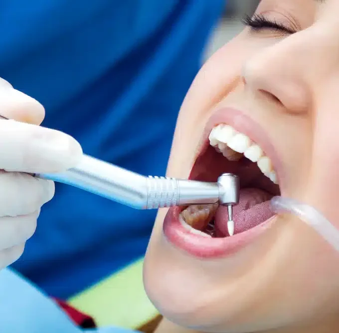 4 questions to ask before combining teeth whitening with routine cleanings