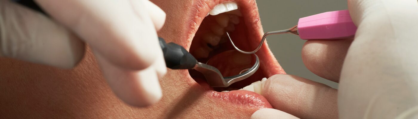 When Cosmetic Dentistry Becomes Restorative Dentistry In Disguise
