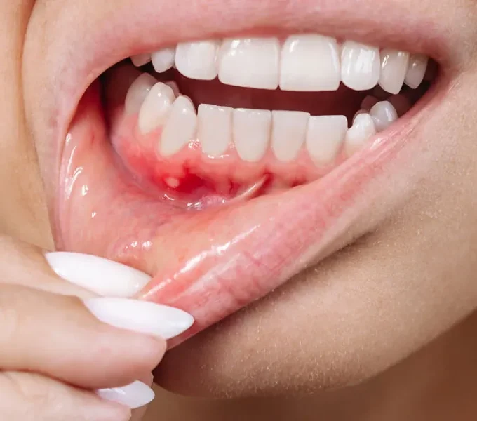 4 signs a tooth infection may be spreading