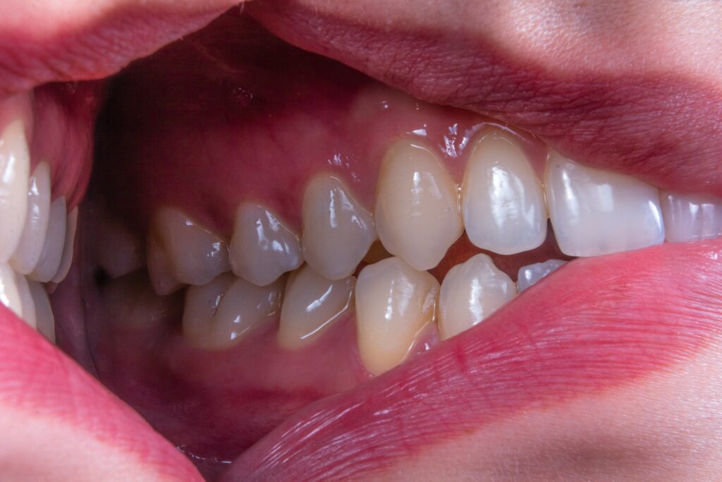 what counts as normal tooth eruption a parents timeline guide