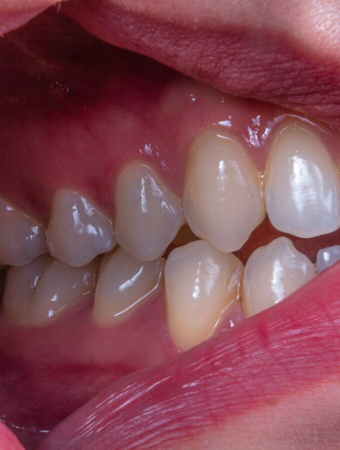 Ozkan guner 8xony1ibeai unsplash Live Sv why preventive dentistry is key to preserving natural teeth