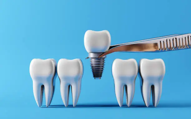 5 Benefits Of Dental Implants In Restorative Dentistry